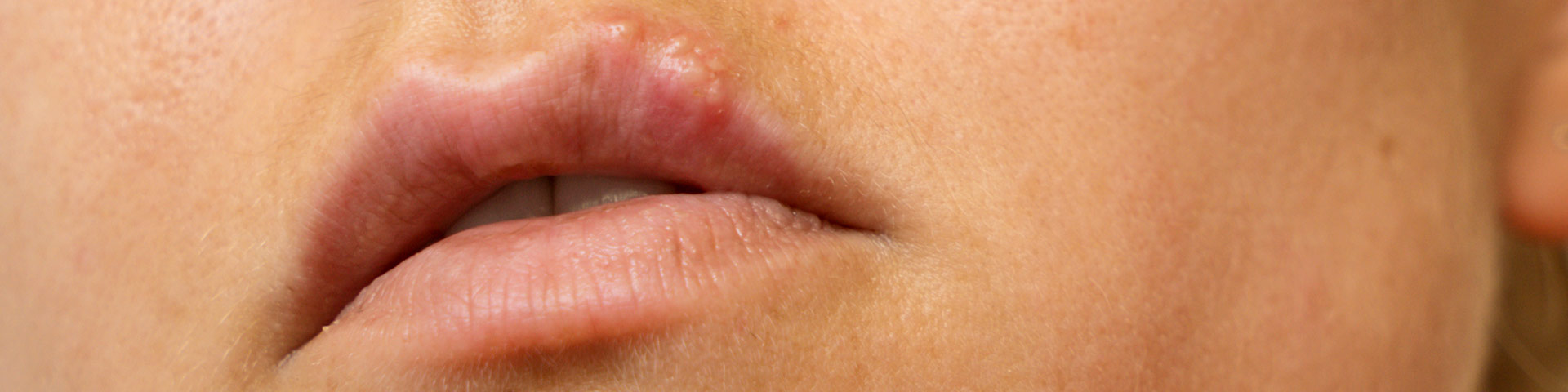 Skincare: Cold Sore