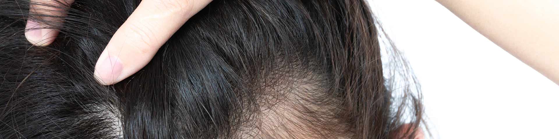 Skincare: Scalp Psoriasis