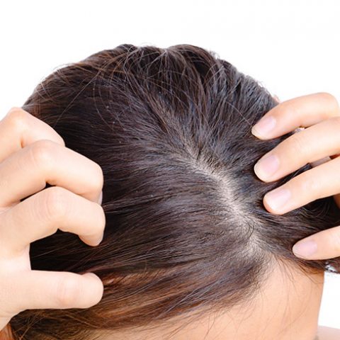scalp-psoriasis-img-1